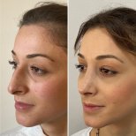 نتائج عملية تجميل الأنف قبل وبعد في Assoc.Prof.Dr.Cemal Kara / Medical Park İzmir Hospital