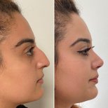 نتائج عملية تجميل الأنف قبل وبعد في Assoc.Prof.Dr.Cemal Kara / Medical Park İzmir Hospital