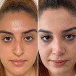 Resultados de rinoplastia antes y después en Assoc.Prof.Dr.Cemal Kara / Medical Park İzmir Hospital