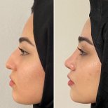 نتائج عملية تجميل الأنف قبل وبعد في Assoc.Prof.Dr.Cemal Kara / Medical Park İzmir Hospital