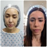 Результаты до и после подтяжки лица в Hospital de la Familia, омоложение лица
