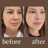 نتائج شد الوجه المصغر قبل وبعد في ID Clinic Bangkok، تجديد شباب الوجه