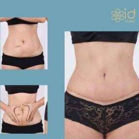 Vorher-nachher-Ergebnis Bauchdeckenstraffung bei ID Clinic Bangkok, verbesserte Bauchform