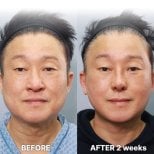 Résultat lifting visage avant et après 2 semaines chez Returning Plastic Surgery, rajeunissement