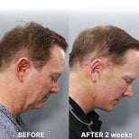 Résultats lifting visage avant/après chez Returning Plastic Surgery, amélioration cou et mâchoire