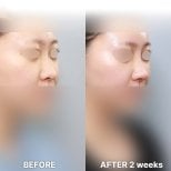 Vorher-nachher-Ergebnis der Nasenkorrektur bei Returning Plastic Surgery nach 2 Wochen