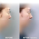 Vorher-nachher-Rhinoplastik-Ergebnisse bei Returning Plastic Surgery, Nasenkorrektur nach 1 Woche