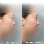 Vorher-nachher-Rhinoplastik-Ergebnis bei Returning Plastic Surgery, Nase nach 2 Wochen