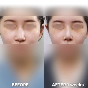 Vorher-nachher-Ergebnis der Nasenkorrektur bei Returning Plastic Surgery, nach 1 Woche