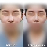 Vorher-nachher-Ergebnis der Nasenkorrektur bei Returning Plastic Surgery, nach 1 Woche
