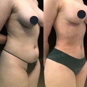 Liposuktion Vorher-Nachher-Ergebnisse bei Memorial Göztepe Hospital, verbesserte Körperform
