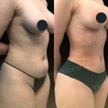 Liposuktion Vorher-Nachher-Ergebnisse bei Memorial Göztepe Hospital, verbesserte Körperform