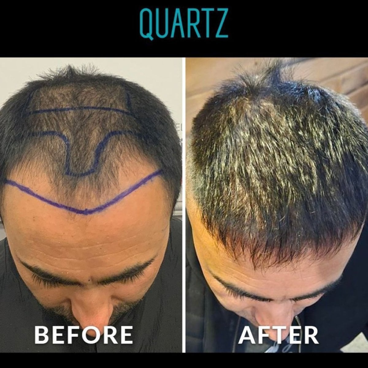 Resultados antes y después de trasplante capilar No Shave en Quartz Hospital, mayor densidad