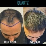 Before and after No Shave Hair Transplant results at Quartz Hospital, improved hair density