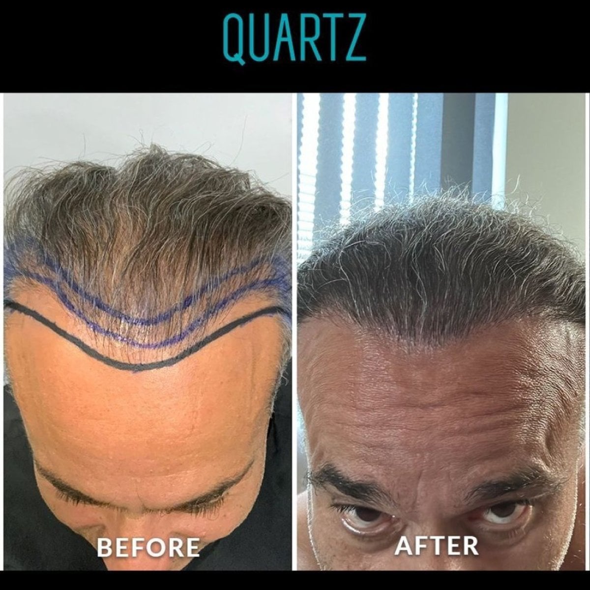 Resultados antes y después de trasplante capilar No Shave en Quartz Hospital, línea restaurada