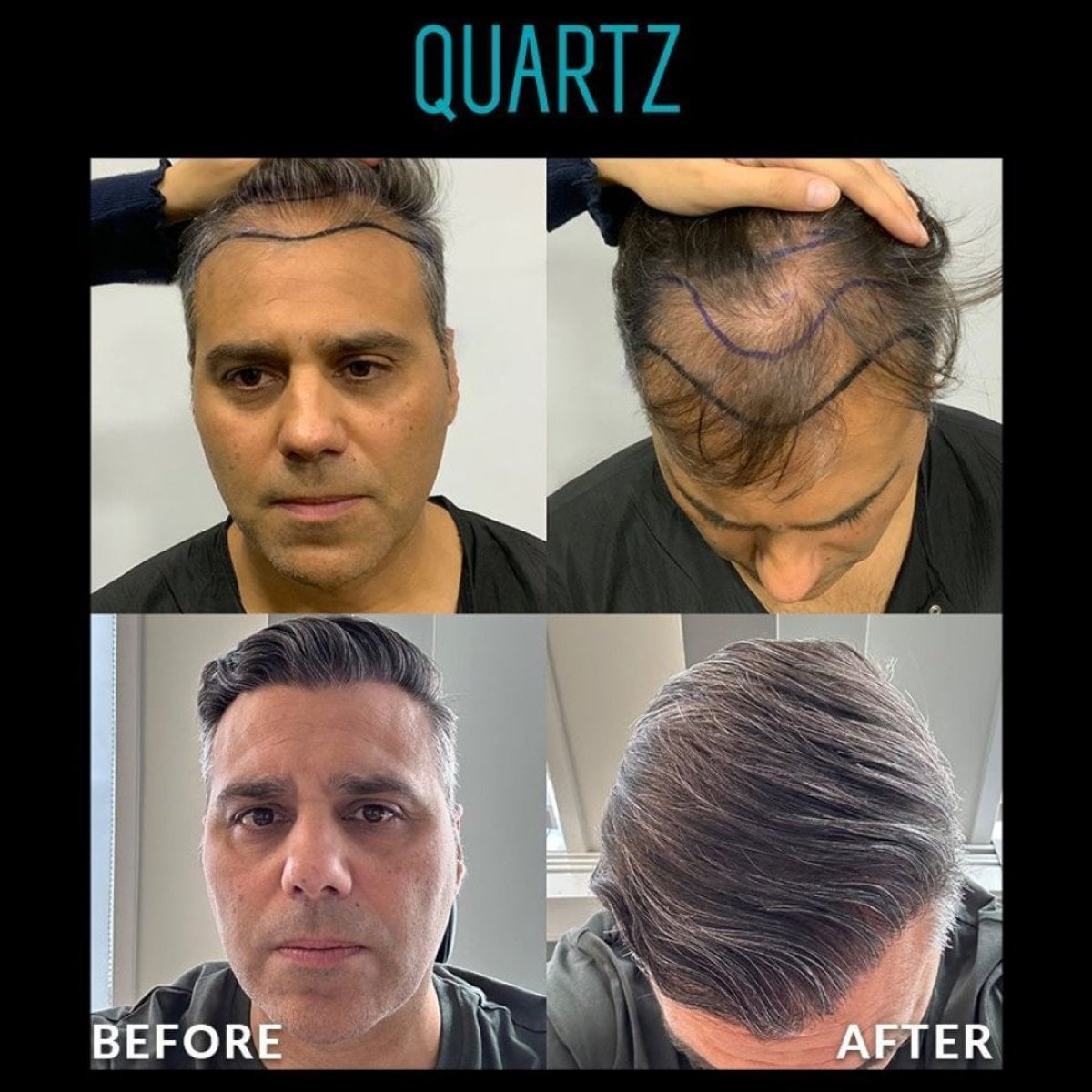 نتائج زراعة الشعر بدون حلاقة قبل وبعد في Quartz Hospital، استعادة خط الشعر