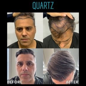 Before and after No Shave Hair Transplant results at Quartz Hospital, restored hairline
