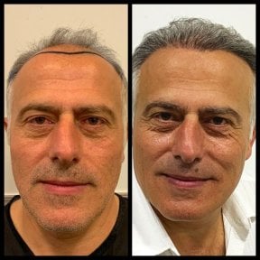 Before and after No Shave Hair Transplant result at Quartz Hospital, improved hairline