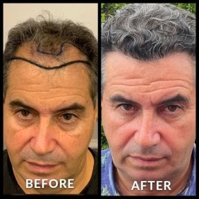 Before and after No Shave Hair Transplant results at Quartz Hospital, restored hairline
