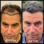 Before and after No Shave Hair Transplant results at Quartz Hospital, restored hairline