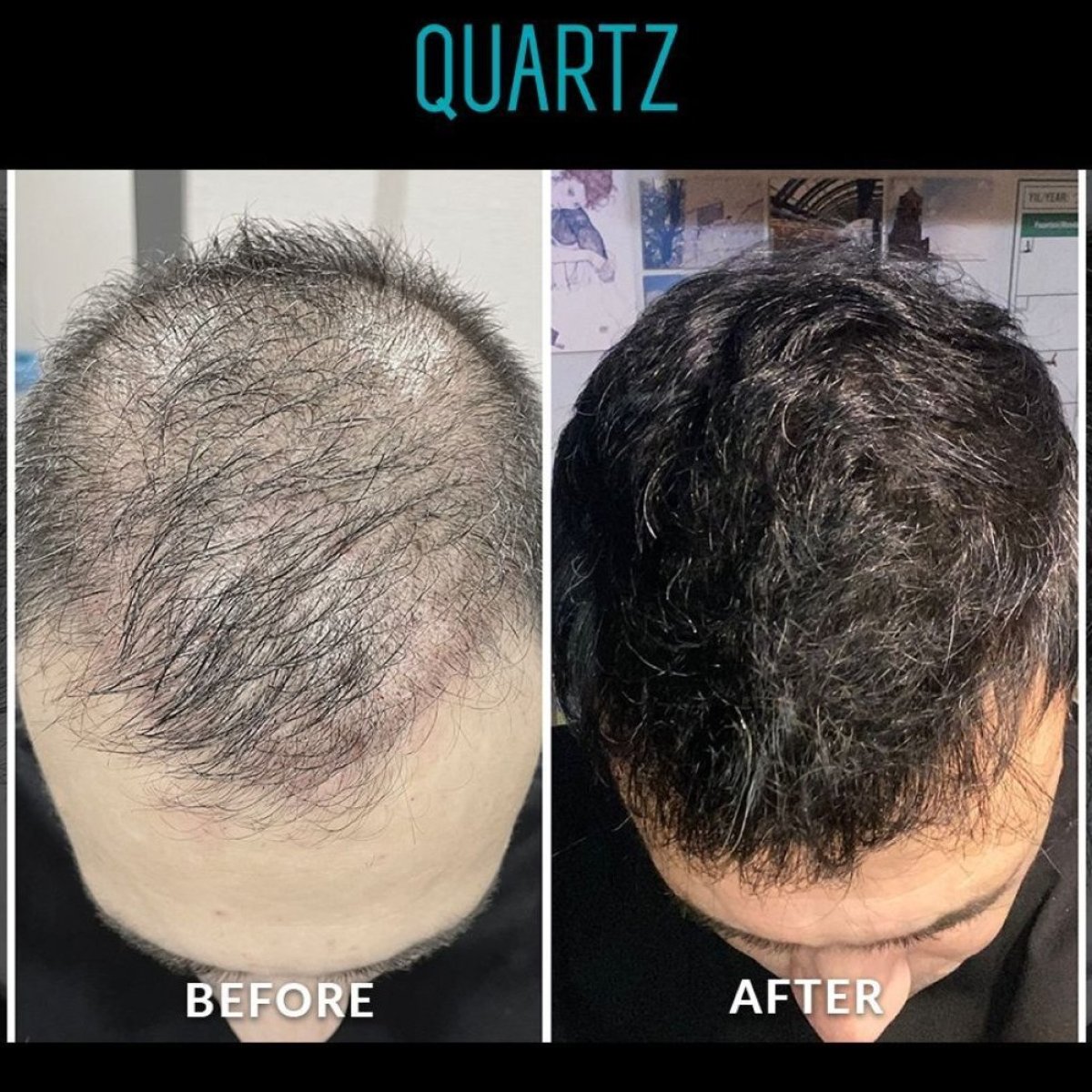 نتائج زراعة الشعر بدون حلاقة قبل وبعد في Quartz Hospital، استعادة كثافة الشعر