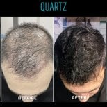 Before and after No Shave Hair Transplant results at Quartz Hospital, fuller hair restoration
