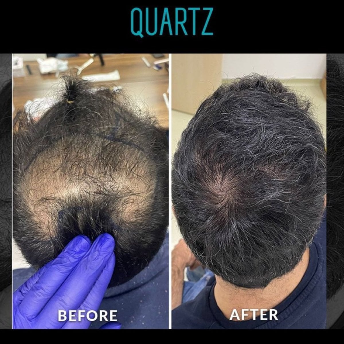 Antes y después de trasplante capilar No Shave en Quartz Hospital – mayor densidad capilar