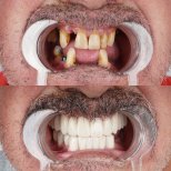 Before and after dental implant with crown at Dent48 Oral and Dental Health Polyclinics result