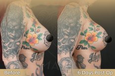 Vorher-nachher-Ergebnis Brustimplantat-Revision bei Dr. Safa Manav Klinik, 6 Tage post-op