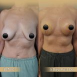 Vorher-nachher-Ergebnisse Brustimplantat-Revision bei Dr. Safa Manav Clinic, verbesserte Form