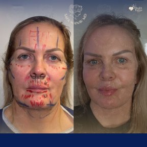 Vorher-nachher-Facelift-Ergebnisse in der Dr. Safa Manav Klinik, sichtbare Verjüngung