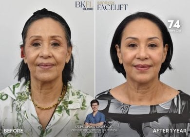Efekty liftingu szyi przed i po w BKFL Clinic – widoczne odmłodzenie po roku