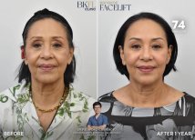 Efekty liftingu szyi przed i po w BKFL Clinic – widoczne odmłodzenie po roku