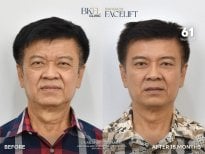 Efekty przed i po liftingu szyi w BKFL Clinic – odmłodzenie twarzy po 18 miesiącach