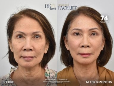 Efekty przed i po liftingu szyi w BKFL Clinic, widoczne odmłodzenie skóry