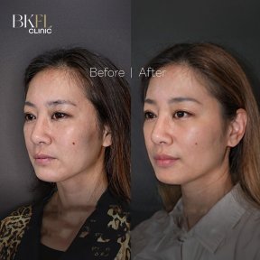 نتائج شد الوجه AccuTite قبل وبعد في BKFL Clinic، تحسين واضح لتحديد الوجه