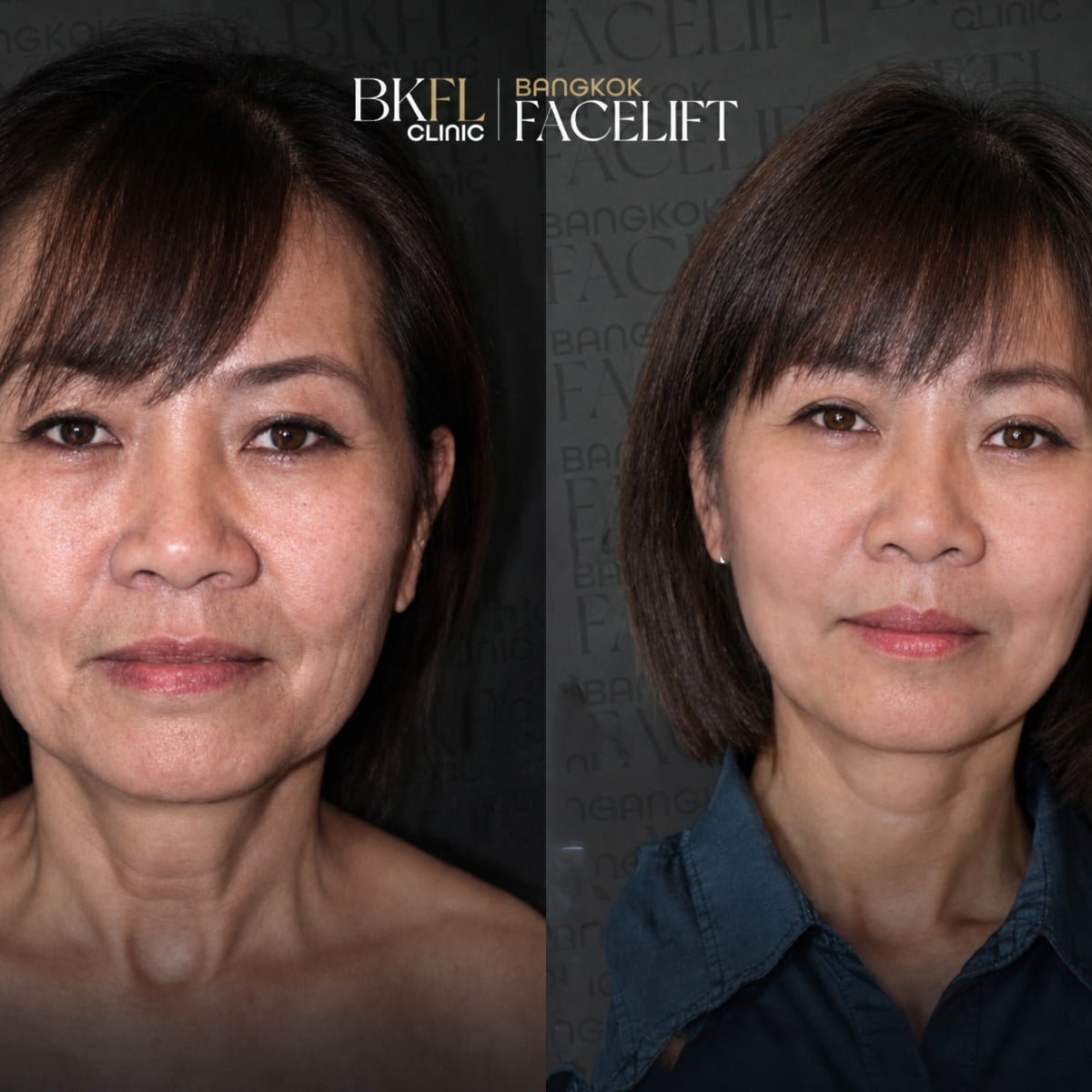 Resultados antes y después de lifting facial AccuTite en BKFL Clinic – rejuvenecimiento facial