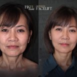 نتائج شد الوجه AccuTite قبل وبعد في BKFL Clinic – تجديد شباب الوجه