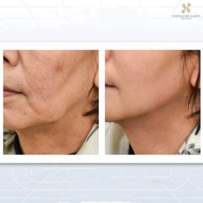 Vorher-nachher-Ergebnis Morpheus8 Hautstraffung bei BKFL Clinic, festere Gesichtshaut