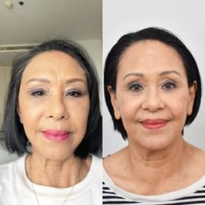 Vorher-nachher-Ergebnis Morpheus8 Hautstraffung im Gesicht bei BKFL Clinic