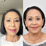 Vorher-nachher-Ergebnis Morpheus8 Hautstraffung im Gesicht bei BKFL Clinic