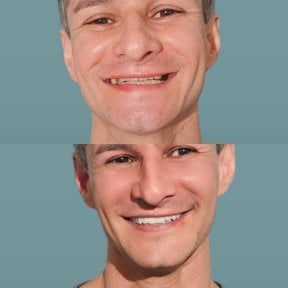 Vorher-nachher Veneers bei KLİNİKEN – natürliches Lächeln nach Behandlung