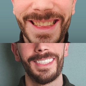 Vorher-nachher-Ergebnis Zahnaufhellung bei KLİNİKEN, sichtbar strahlenderes Lächeln