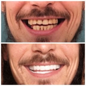 До и после установки зубного импланта с коронкой в KLİNİKEN, результат улыбки
