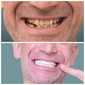 До и после установки зубного импланта с коронкой в KLİNİKEN, восстановленная улыбка