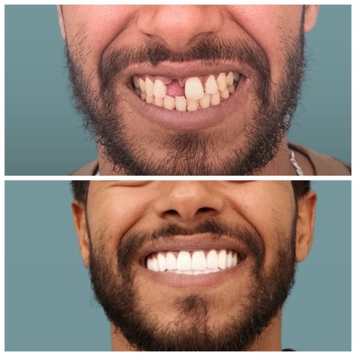 Antes y después de implante dental con corona en KLİNİKEN – sonrisa restaurada y resultado