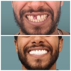 До и после установки зубного импланта с коронкой в KLİNİKEN – восстановленная улыбка