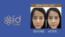 نتائج شد الوجه المصغر قبل وبعد في ID Clinic Bangkok، تجديد واضح للوجه