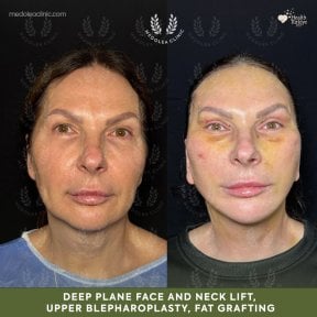 Facelift before and after results at Medolea Clinic – deep plane lift, blepharoplasty, fat grafting