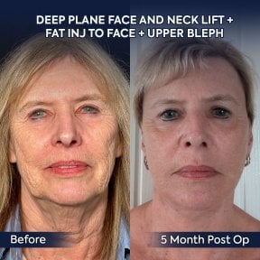 Before and after facelift and neck lift results at Dr. Safa Manav Clinic, 5 months post-op